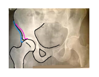 arthrose hanche cavalier